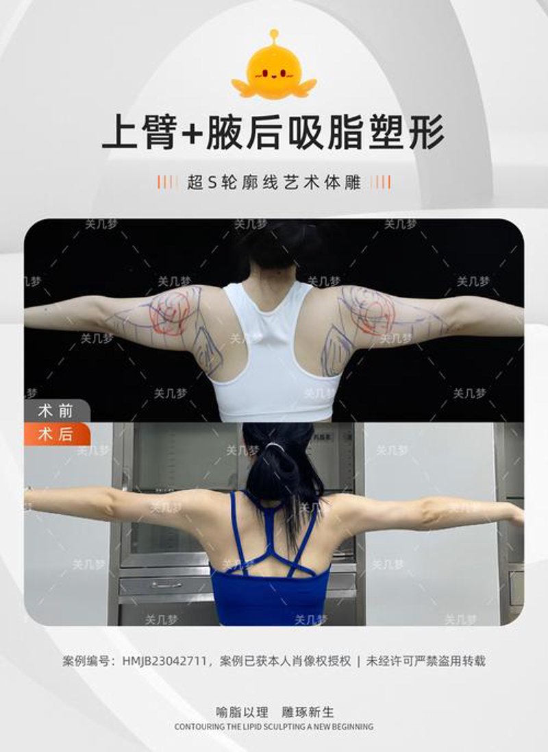 吸脂塑形