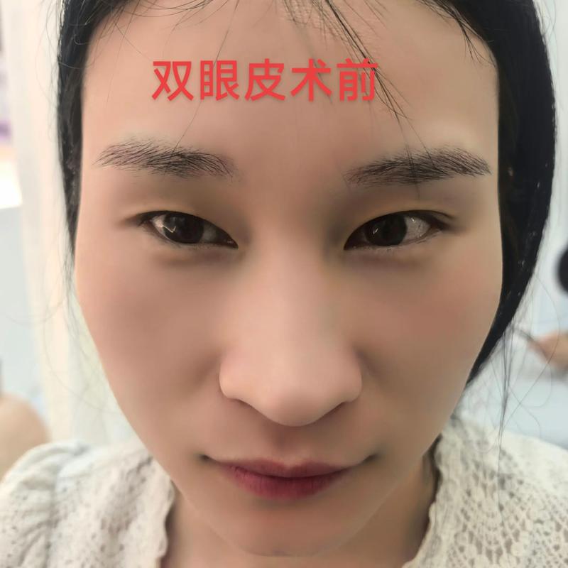 激光祛斑：科技之美，焕发光彩
